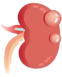 Cisto Renal